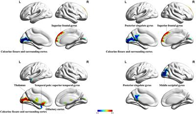 Rich-Club Analysis of Structural Brain Network Alterations in HIV Positive Patients With Fully Suppressed Plasma Viral Loads